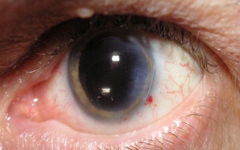 Here's another reason for you to get cataract surgery