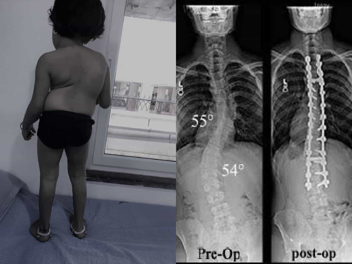 Doctors save a 6-year old girl from lifelong deformity