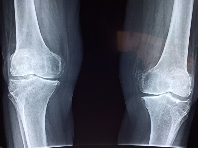 Turmeric supplement effective in osteoarthritis knee pain: Study